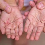 Manuel ayak hastalığının belirtileri nelerdir? El ayak hastalığı nasıl anlaşılır? Tedavi yöntemleri nelerdir?